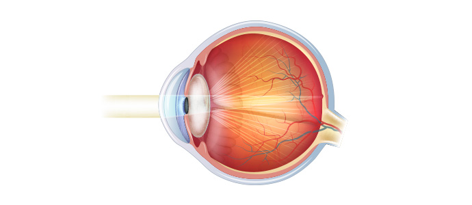 고도근시안 백내장
