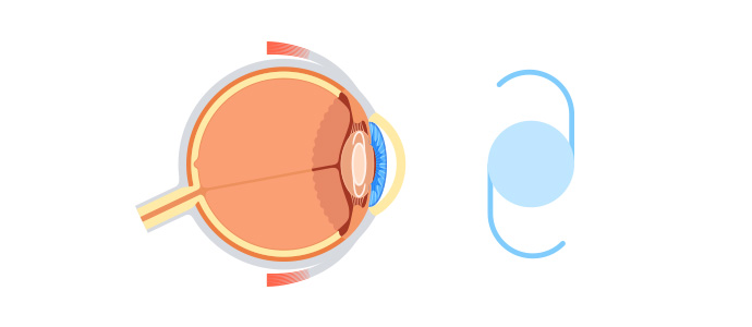 인공수정체 재고정술