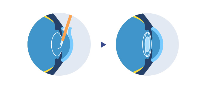 새 인공수정체 고정