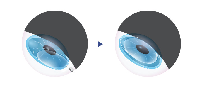 기존 인공수정체 재고정술