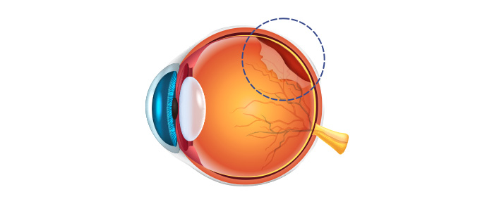 열공성 망막박리