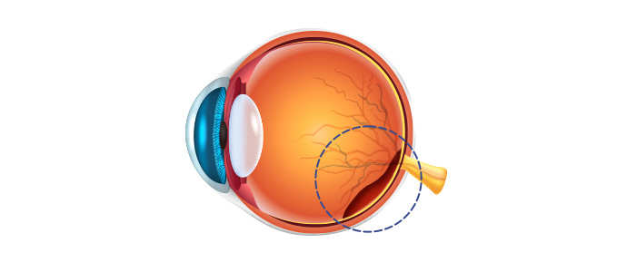 삼출성 망막박리