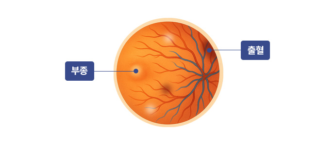 비증식성 당뇨망막병증