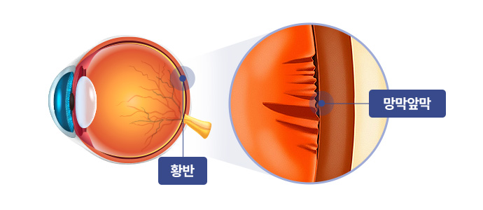 망막전막(황반주름)