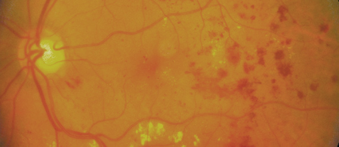 중심망막정맥폐쇄