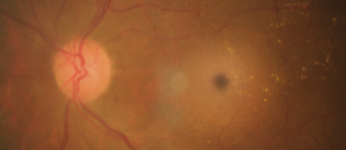 중심망막동맥폐쇄