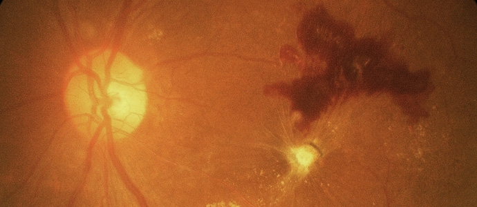 분지망막정맥폐쇄