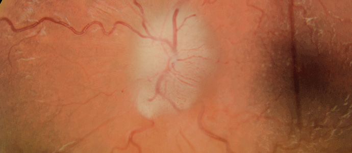 분지망막동맥폐쇄