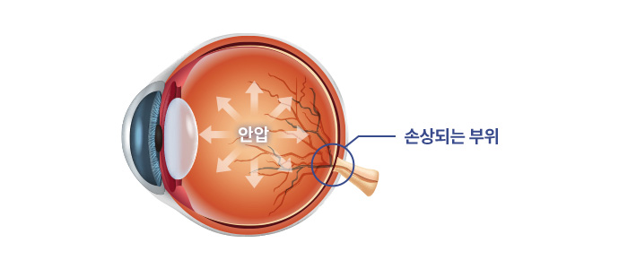 정상안압 녹내장